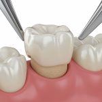 dental crown placement rendering